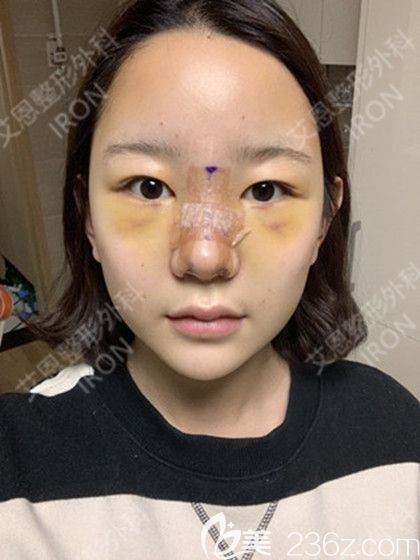 艾恩整形術后第7天 艾恩整形術后第7天