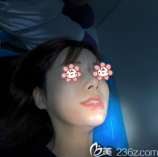 ?深圳南雅整形厚唇改薄術(shù)后7天恢復(fù)過程全紀(jì)錄