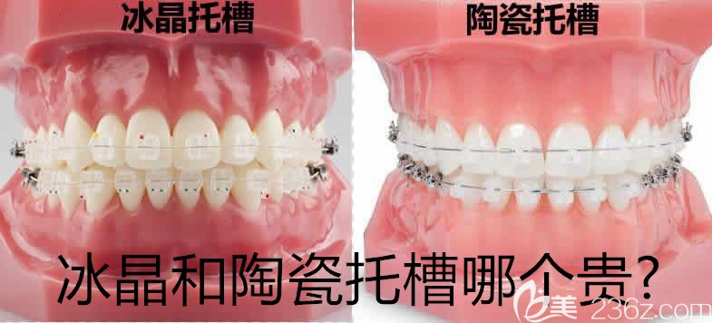 要問冰晶和陶瓷托槽哪個(gè)貴?其實(shí)深圳美萊口腔冰晶與陶瓷牙套價(jià)格差也就7000多元