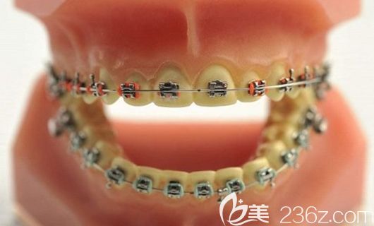 張子揚(yáng)醫(yī)生擅長(zhǎng)各類牙性畸形的矯治