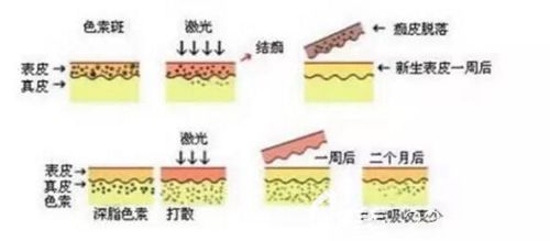 美國(guó)賽諾秀755翠綠寶石激光祛斑