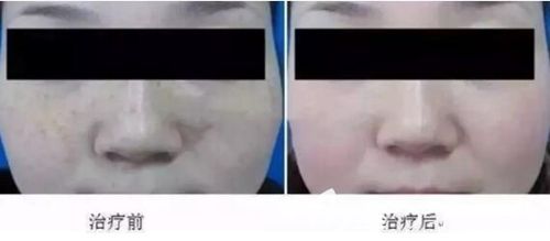 許昌博愛美國(guó)賽諾秀激光祛斑實(shí)例