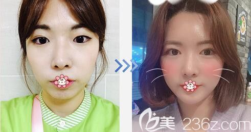 韓國(guó)純真醫(yī)院做自體脂肪全臉填充效果