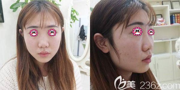 術(shù)前不好看的塌鼻子 術(shù)前不好看的塌鼻子