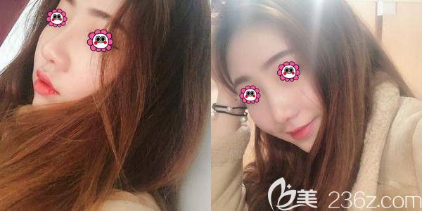 術(shù)后七天膨體鼻綜合的恢復(fù)效果 術(shù)后七天膨體鼻綜合的恢復(fù)效果