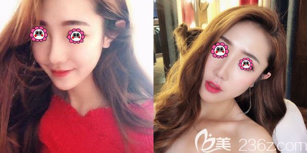 都說日本韓國禁用了膨體材料，但我找南京曹海峰做的假體隆鼻并沒有感染