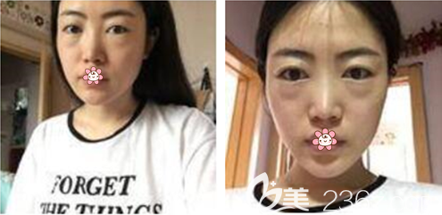 術(shù)前的我 術(shù)前的我