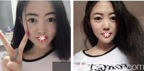 <!--<i data=20240703-sp></i>-->內(nèi)切祛眼袋術(shù)后半個月 <!--<i data=20240703-sp></i>-->內(nèi)切祛眼袋術(shù)后半個月