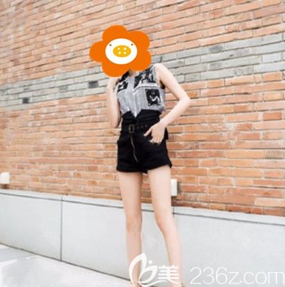 做完吸脂瘦腿半個(gè)月沒穿塑腿褲 做完吸脂瘦腿半個(gè)月沒穿塑腿褲