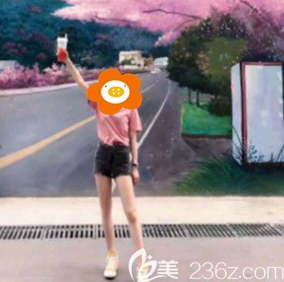 到泉州做大腿吸脂滿(mǎn)三個(gè)月，今天來(lái)聊聊我的心路歷程