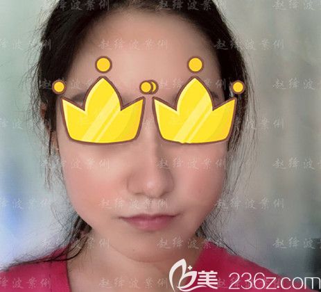 做下頜角整形手術(shù)前 做下頜角整形手術(shù)前