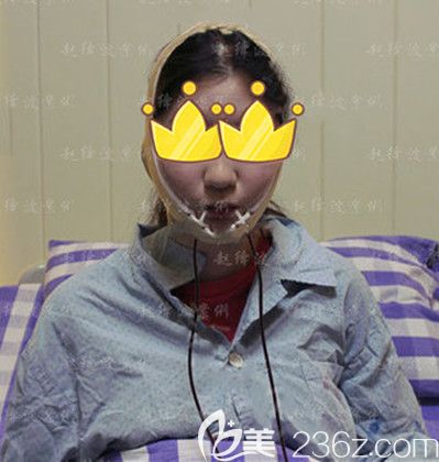 做完下頜角整形手術(shù)當(dāng)天 做完下頜角整形手術(shù)當(dāng)天