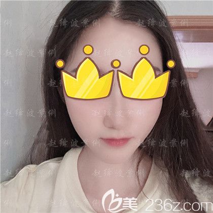 下頜角整形手術(shù)1個(gè)月 下頜角整形手術(shù)1個(gè)月