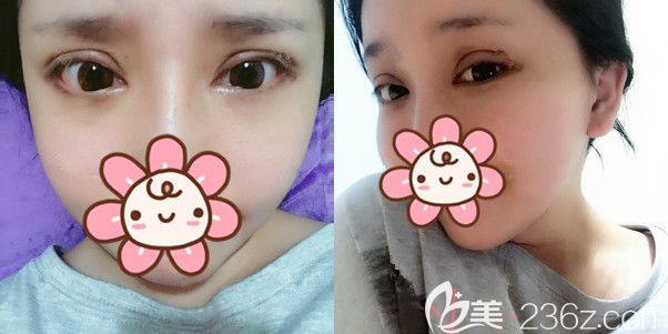 一周到泰州麗都拆線眼睛已經(jīng)基本消腫 一周到泰州麗都拆線眼睛已經(jīng)基本消腫