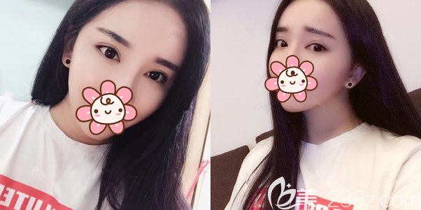 前段時間剛在泰州麗都做完眼部綜合的我來說說恢復那些事兒