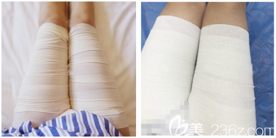 深圳富華大腿抽脂5天恢復(fù)效果 深圳富華大腿抽脂5天恢復(fù)效果