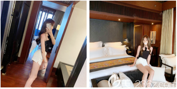 大腿吸脂術(shù)后兩個(gè)月反饋照片 大腿吸脂術(shù)后兩個(gè)月反饋照片