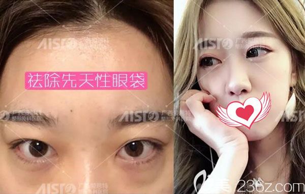 廣西愛思特做內切去眼袋的術前術后對比照 廣西愛思特做內切去眼袋的術前術后對比照