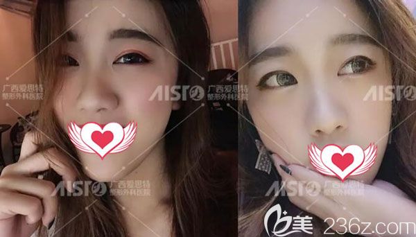 廣西內(nèi)切祛眼袋案例來(lái)報(bào)到，說(shuō)一下我是在南寧愛(ài)思特做的手術(shù)