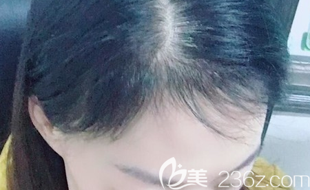 重慶華膚醫(yī)院孫乘林植發(fā)2555單位5個(gè)月效果