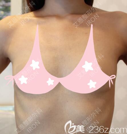 韓國(guó)艾恩術(shù)前自拍照 韓國(guó)艾恩術(shù)前自拍照