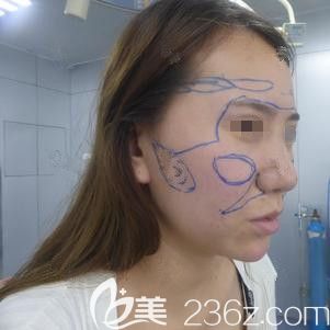 華美醫(yī)生圈出來自體脂肪填充區(qū)域 華美醫(yī)生圈出來自體脂肪填充區(qū)域