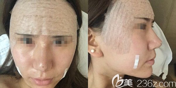 剛做完面部脂肪填充術(shù)后包著紗布 剛做完面部脂肪填充術(shù)后包著紗布