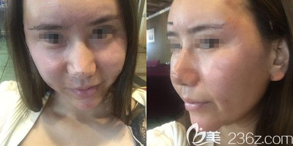 全麻做自體脂肪填充面部術(shù)后三天腫脹 全麻做自體脂肪填充面部術(shù)后三天腫脹