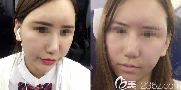 一周后自體脂肪填充面部恢復(fù)情況 一周后自體脂肪填充面部恢復(fù)情況