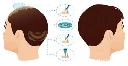 濟(jì)南名韓微針植發(fā)技術(shù) 濟(jì)南名韓微針植發(fā)技術(shù)
