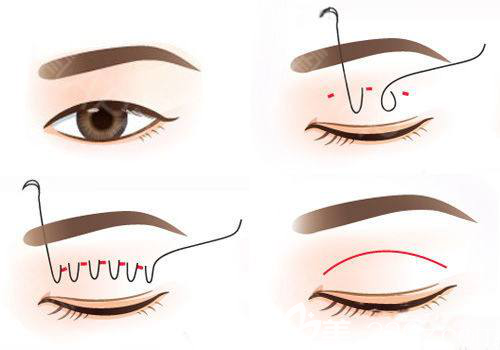 埋線法雙眼皮手術(shù)示意圖