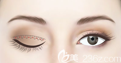 埋線法雙眼皮效果圖