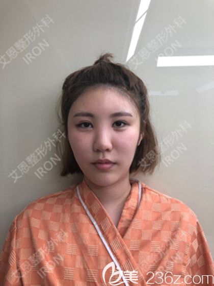 韓國艾恩鼻綜合術(shù)前照 韓國艾恩鼻綜合術(shù)前照