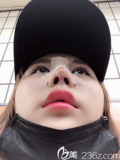 韓國艾恩鼻綜合術(shù)后第3天 韓國艾恩鼻綜合術(shù)后第3天