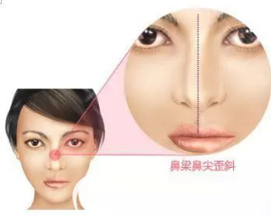 隆鼻后鼻梁鼻尖出現(xiàn)歪斜