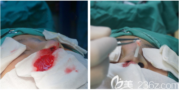 廣州荔灣區(qū)鼻子奧美定取出過程圖 廣州荔灣區(qū)鼻子奧美定取出過程圖