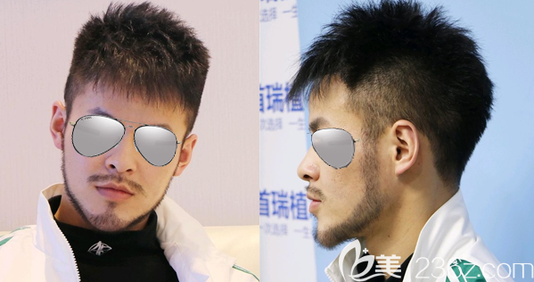 有了在成都首瑞種植w型胡須和鬢角種植的親身經(jīng)歷，我輕松識(shí)破了“植胡須騙局”