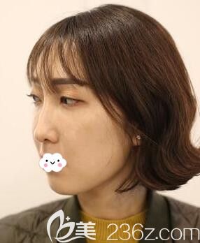 武漢硚口卓美吳秀英全臉埋線提升術(shù)前