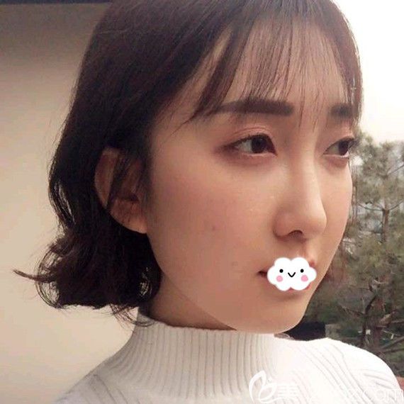 武漢卓美埋線提升術(shù)后側(cè)面恢復(fù)圖