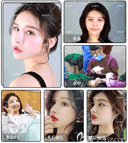 深圳富華整形醫(yī)院斯良洪隆鼻案例