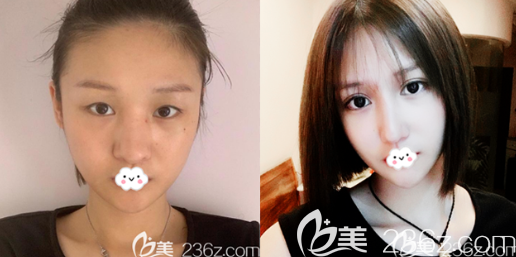 深圳富華醫(yī)院金靈醫(yī)生雙眼皮案例