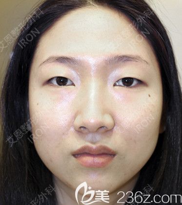 艾恩整形術(shù)前照 艾恩整形術(shù)前照