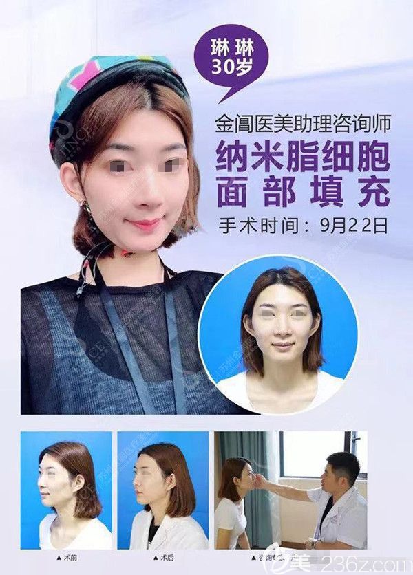 三張面部脂肪填充對比照讓我決定寒假就去蘇州金閶變美