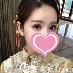 整容老司機(jī)告訴你輕度提肌無力的水泡眼在合肥做的眼部綜合整形效果