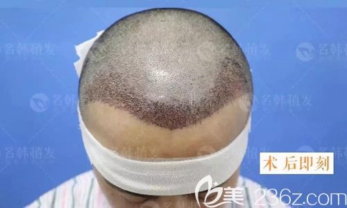 濟南名韓植發(fā)術后即刻效果