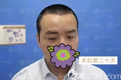 濟南名韓做發(fā)際線種植術后20天