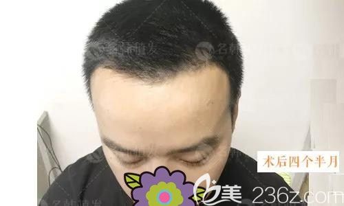我今年30歲因額角大來(lái)濟(jì)南名韓植發(fā)做的前額發(fā)際線種植，現(xiàn)在是術(shù)后4個(gè)月
