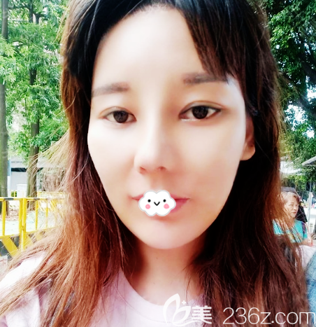 參考朋友的隆鼻效果我也花兩萬多元去廣州找做了鼻子