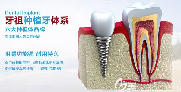 牙祖口腔種植體系 牙祖口腔種植體系