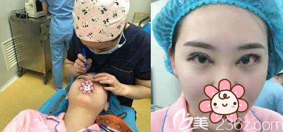 切開雙眼皮+開內(nèi)眼角手術(shù)+上瞼提肌等眼部綜合項目整形中 切開雙眼皮+開內(nèi)眼角手術(shù)+上瞼提肌等眼部綜合項目整形中